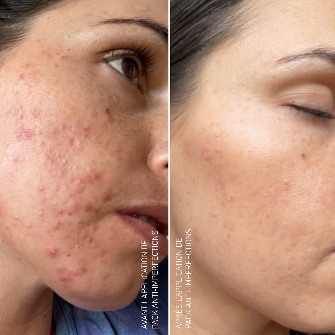 Pack Anti-Imperfections