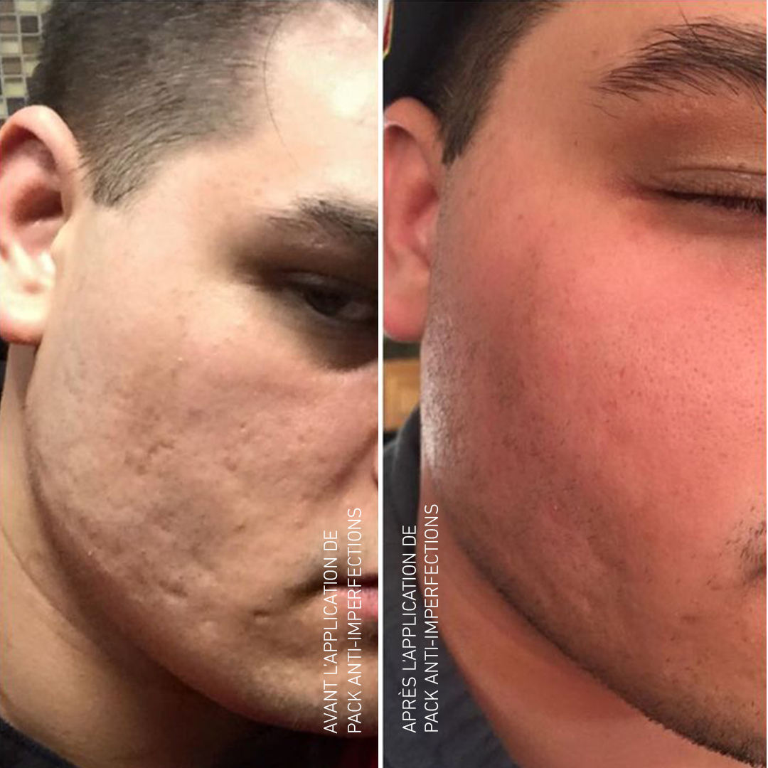 Pack Anti-Imperfections