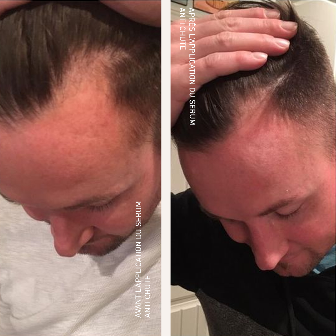 Hair loss control leads