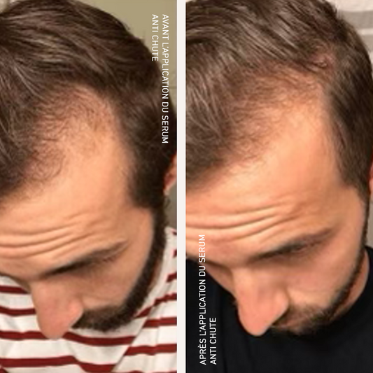 Hair loss control