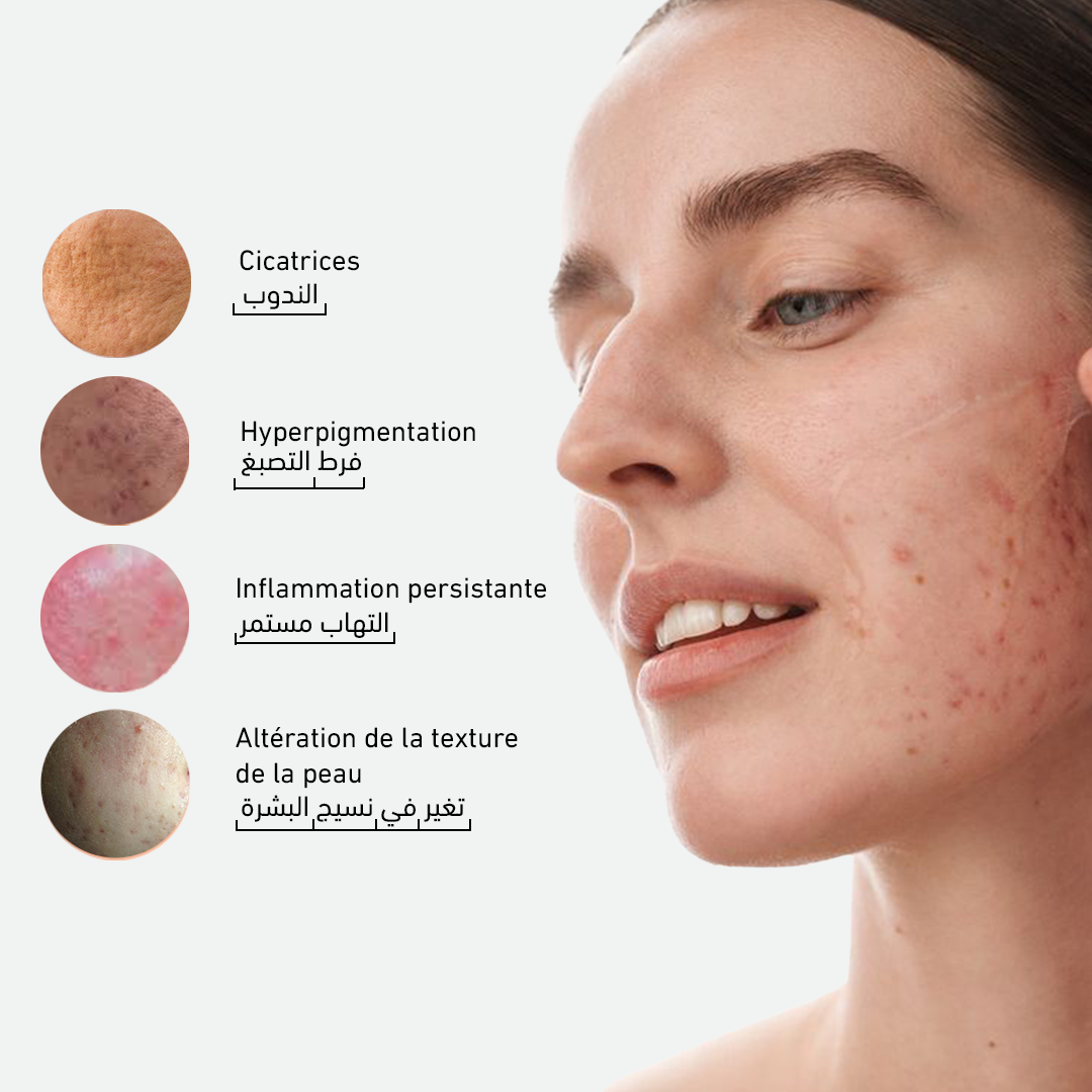 Clear Skin Anti-acné