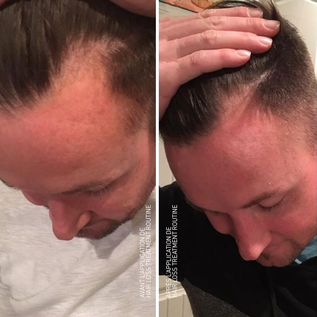 Hair Loss Treatment Routine